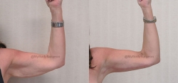 Brachioplasty (Arm Lift) with Liposuction of Arms