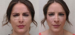 Botox treated in the Frontalis (forehead) and Glabella (between the eyes)