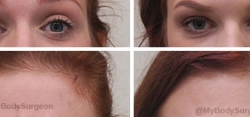 Botox treated in the Frontalis (forehead) and Glabella (between the eyes)