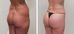 Liposuction of Abdomen, Flanks, Lower Back, Inner & Outer Thighs, Bilateral Fat Transfer to Buttocks