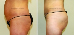 Liposuction of Abdomen - Bilateral Fat Transfer to Buttocks