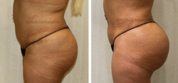 Liposuction of Abdomen - Liposuction of Flanks - Liposuction of Back - Bilateral Fat Transfer to Buttocks
