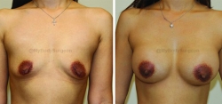 Breast Augmentation - 350 cc High Profile Silicone Gel Implants - Implant Placed Under Muscle - Incision in Breast Crease