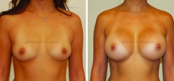 Breast Augmentation - 450 cc High Profile Silicone Implants - Implant Placed Under Muscle - Incision in Breast Crease