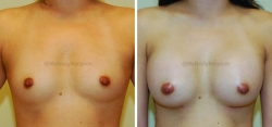 Breast Augmentation - 350 cc High Profile Silicone Implants - Implant Placed Under Muscle - Incision in Breast Crease