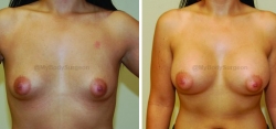 Breast Augmentation - 425 cc High Profile Silicone Gel Implants - Implant Placed Under Muscle - Incision in Breast Crease