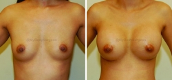 Breast Augmentation - 350 cc High Profile Silicone Implants - Implant Placed Under Muscle - Incision in Breast Crease