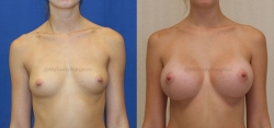 Breast Augmentation - 335 cc 410 Shaped MF (Moderate Height, Full Projection) Silicone Gel Implants - Implant Placed Under Muscle - Incision in Breast Crease