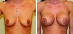 Breast Augmentation - Left 450 cc High Profile Silicone Implant - Right 475 cc High Profile Silicone Implant - Implant Placed Under Muscle - Incision in Breast Crease