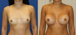 Breast Augmentation - 400 cc HP Silicone Gel Implants - Implant Placed Under Muscle - Incision in Breast Crease
