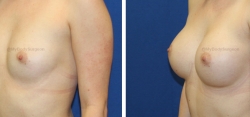 Breast Augmentation - 325 cc HP Silicone Gel Implants - Implant Placed Under Muscle - Incision in Breast Crease