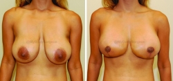 Breast Lift - Breast Augmentation - 450 cc High Profile Silicone Implants - Implant Placed Under Muscle