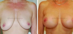 Breast Lift - Breast Augmentation - 325 cc High Profile Silicone Implants - Implant Placed Under Muscle No Skin Removed