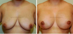 Breast Lift - Breast Augmentation - 375 cc High Profile Silicone Implants - Implant Placed Under Muscle