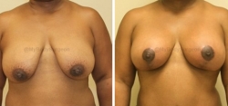 Breast Lift - Breast Augmentation - 250 cc High Profile Silicone Implants - Implant Placed Under Muscle