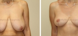 Breast Lift - No Implants