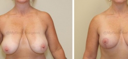 Breast Lift - Breast Augmentation - 350 cc High Profile Silicone Implants - Implant Placed Under Muscle