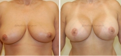 Breast Lift - Breast Augmentation - 325 cc High Profile Silicone Implants - Implant Placed Under Muscle