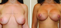Breast Lift - Breast Augmentation - 350 cc High Profile Silicone Implants - Implant Placed Under Muscle
