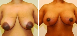 Breast Lift - No Implants