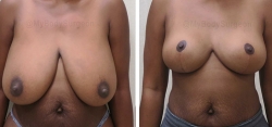Breast Lift - No Implants (Better Breast Lift)