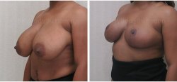 Breast Lift - Breast Reduction - No Implants-Better Breast Lift
