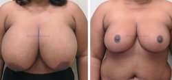Breast Lift / Reduction