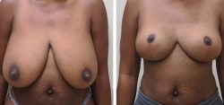 Breast Lift / Reduction (Better Breast Lift)