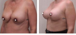 P1-breast-revision-lift