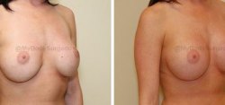 P1-revision_breast_surgery-copy-2