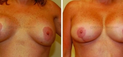 Breast Lift Revision - 300 cc HP Silicone Gel Implants - Implant Placed Under Muscle