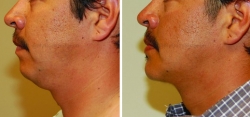 Chin Implant - Liposuction of neck