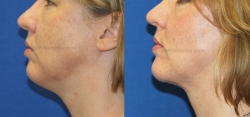 Chin implant placement