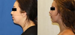 Chin implant placement - Liposuction of neck