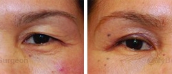 Upper eyelid surgery -Surgery performed in office.