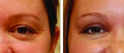 Upper Eyelid Surgery - Performed in our office.