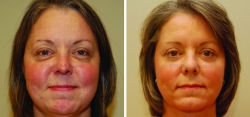 Upper and Lower Eyelid Surgery - Cheek Fat Reduction - Chin Liposuction