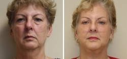 Face Lift - Upper and Lower Eyelid lift