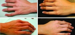 Hand Rejuvenation with 2 1.5 cc Syringes of Radiesse®