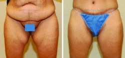 Inner Thigh Lift Incision placed in Crease of Groin