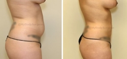 Liposuction of Abdomen - Liposuction of Flanks