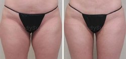 Liposuction of the Inner Thighs
