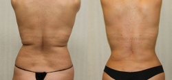 Liposuction of Upper & Lower Back