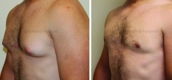 Gynecomastia Reduction - Liposuction of Chest - Excision of Excess Breast Tissue