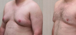 Gynecomastia Reduction - Liposuction of Chest - Excision of Excess Breast Tissue