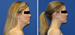 Neck Lift - Liposuction of Neck - Tightening of Platysma Muscle