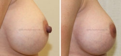 Bilateral Nipple Reduction