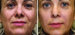 2 Syringes of JUVÉDERM® Ultra Plus XC Injected into Nasolabial Folds (smile lines).