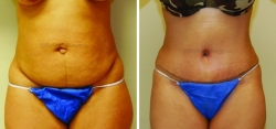 Abdominoplasty - Liposuction of Abdomen - Liposuction of Flanks - Belly Button Revision - Liposuction of Inner & Outer Thighs