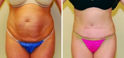 Abdominoplasty - Liposuction of Abdomen - Liposuction of Flanks - Belly Button Revision
